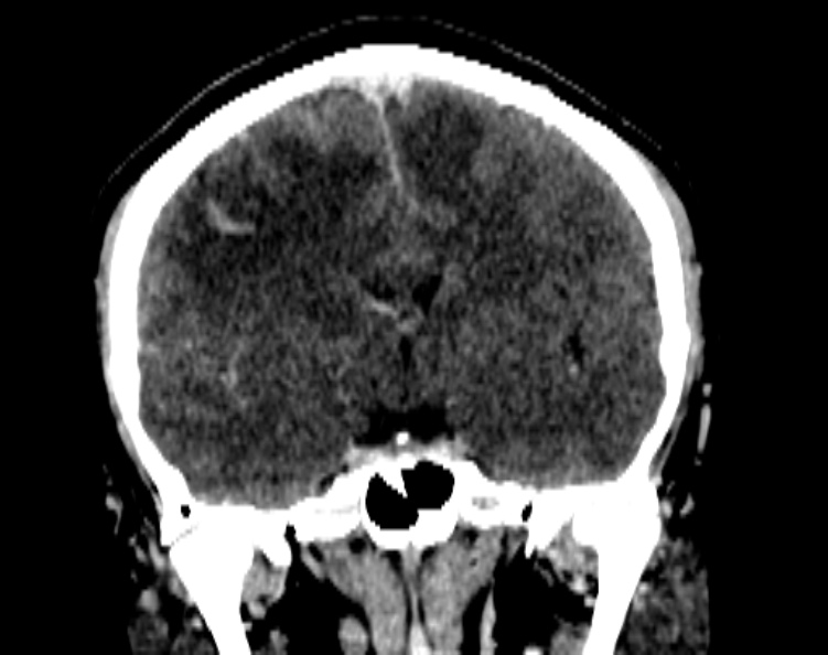 Cerebral venous hemorrhagic infarct from venous sinus thrombosis (Radiopaedia 55433-61883 Coronal C+ delayed 32).jpg