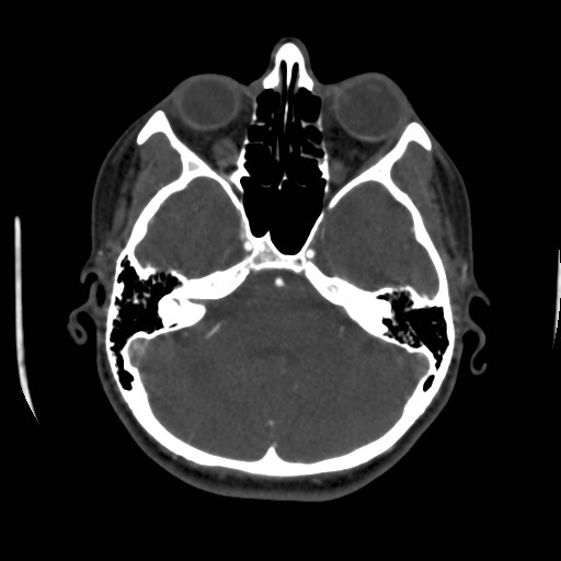 Cerebral venous sinus thrombosis (Radiopaedia 40619-43227 A 60).jpg