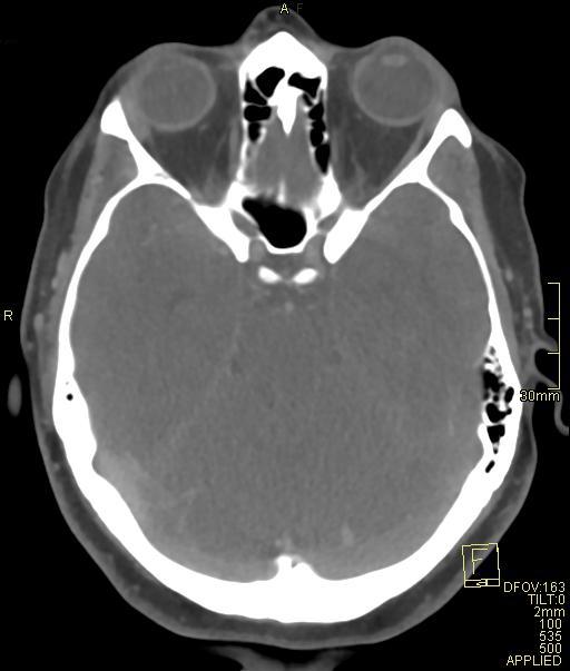Cerebral venous sinus thrombosis (Radiopaedia 91329-108965 Axial venogram 30).jpg