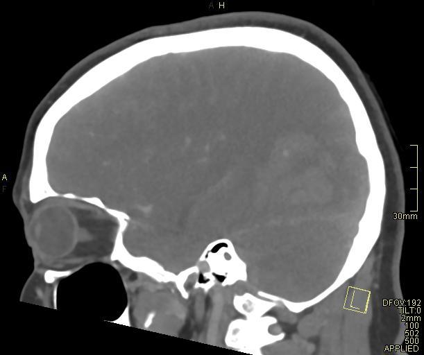Cerebral venous sinus thrombosis (Radiopaedia 91329-108965 Sagittal venogram 53).jpg