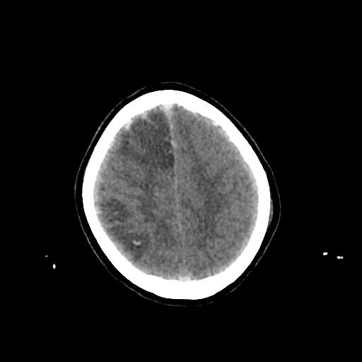 File:Cerebral venous throbmosis - hemorrhagic venous infarction (Radiopaedia 87318-103613 Axial non-contrast 138).jpg