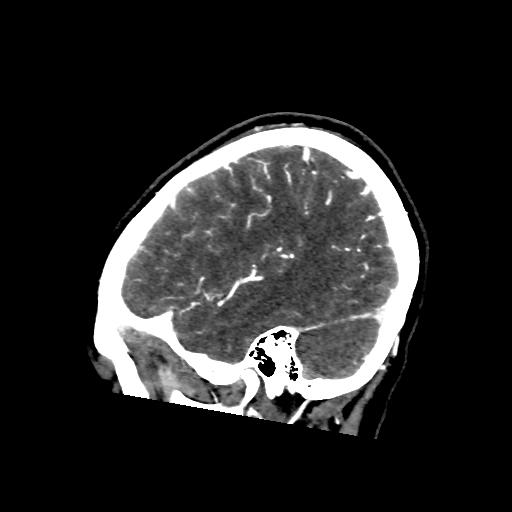 File:Cerebral venous throbmosis - hemorrhagic venous infarction (Radiopaedia 87318-103613 Sagittal CT venogram 38).jpg