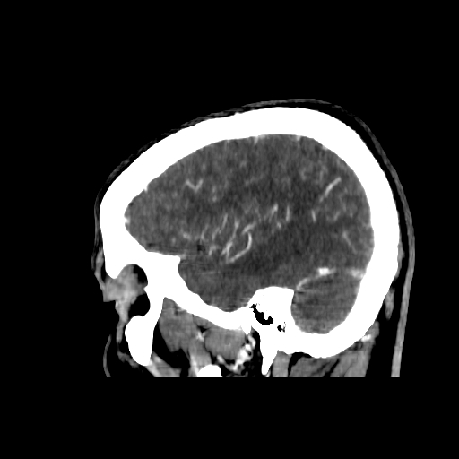 File:Cerebral venous thrombosis (CVT) (Radiopaedia 77524-89685 Sagittal CTV 38).jpg