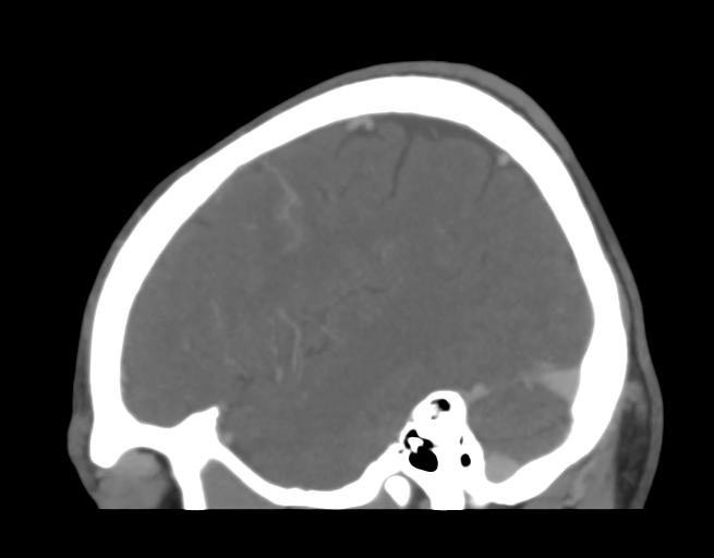 File:Cerebral venous thrombosis (Radiopaedia 38392-40467 D 12).png