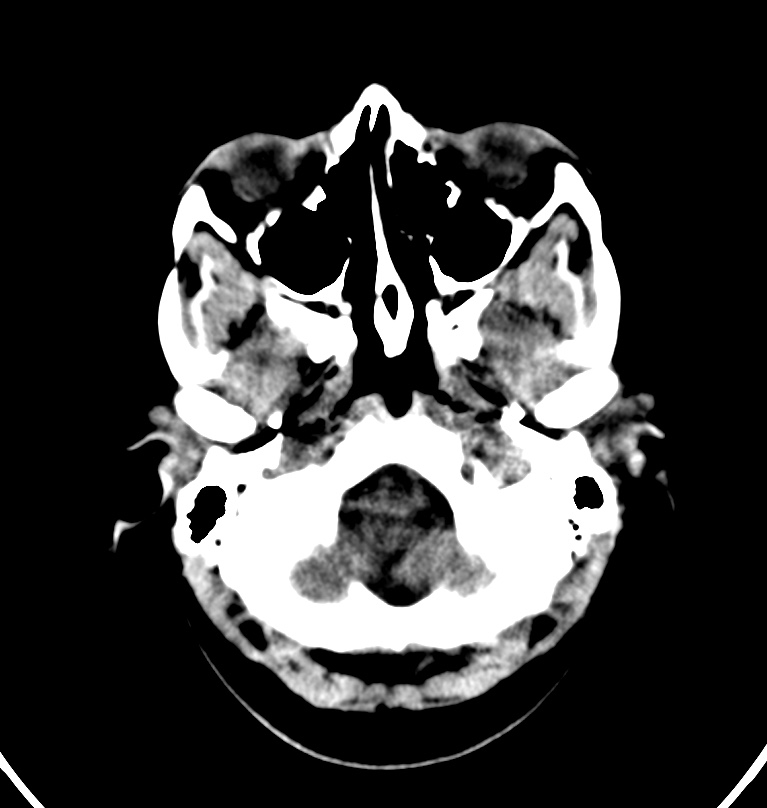Cerebral venous thrombosis - CT only (Radiopaedia 41031-43778 Axial non-contrast 78).jpg