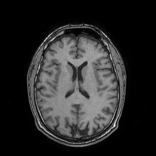 File:Cerebral venous thrombosis with secondary intracranial hypertension (Radiopaedia 89842-106957 Axial T1 107).jpg