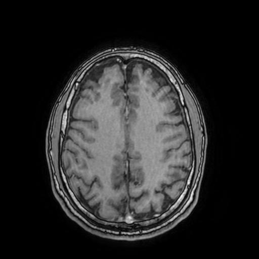 File:Cerebral venous thrombosis with secondary intracranial hypertension (Radiopaedia 89842-106957 Axial T1 C+ 124).jpg