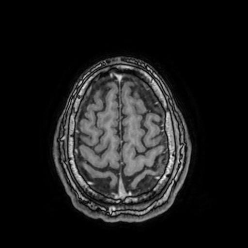 File:Cerebral venous thrombosis with secondary intracranial hypertension (Radiopaedia 89842-106957 Axial T1 C+ 144).jpg