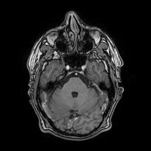 File:Cerebral venous thrombosis with secondary intracranial hypertension (Radiopaedia 89842-106957 Axial T1 C+ 62).jpg