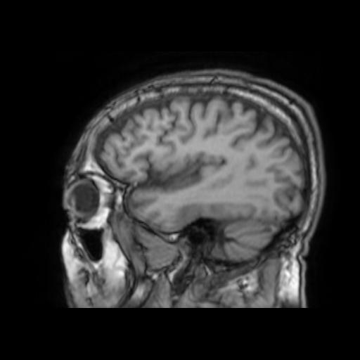 File:Cerebral venous thrombosis with secondary intracranial hypertension (Radiopaedia 89842-106957 Sagittal T1 8).jpg