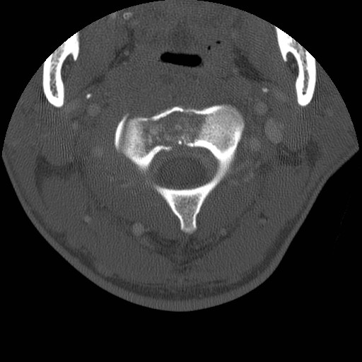 Cervical Pott disease (Radiopaedia 20374-20286 Axial bone window 34).jpg