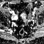 File:Cervical adenocarcinoma (Radiopaedia 65011-73985 Axial ADC 19).jpg