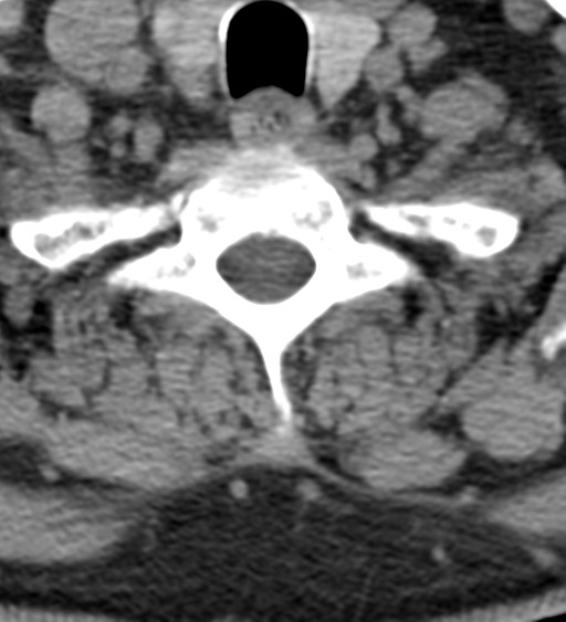 File:Cervical canal stenosis - OPLL and osteophytes (Radiopaedia 47329-51910 Axial non-contrast 52).png