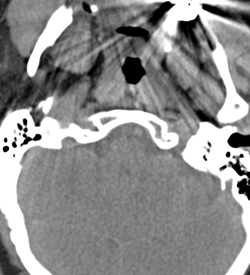 File:Cervical canal stenosis due to ossification of the posterior longitudinal ligament (Radiopaedia 47260-51823 Axial non-contrast 5).png