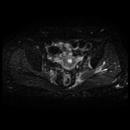 File:Cervical carcinoma (Radiopaedia 70924-81132 Axial DWI 7).jpg