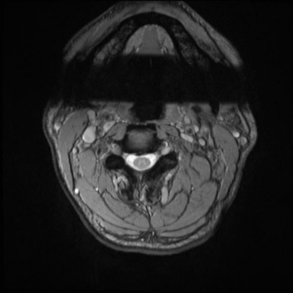 File:Cervical disc extrusion (Radiopaedia 53950-60077 Axial T2 6).jpg