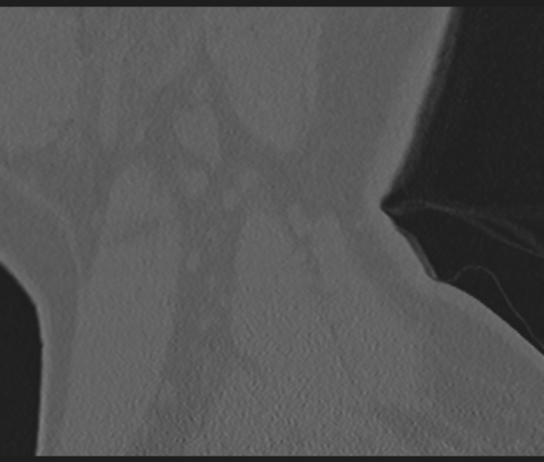 Cervical disc replacement (Radiopaedia 44025-47541 Sagittal bone window 7).png