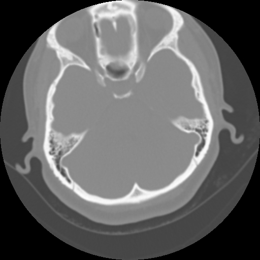 File:Cervical rib (Radiopaedia 71110-81363 Axial non-contrast 4).jpg