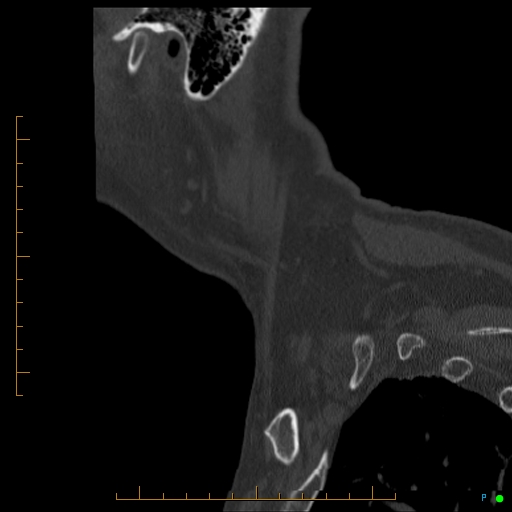 Cervical spine fracture - ankylosing spondylitis (Radiopaedia 76835-88706 Sagittal bone window 5).jpg
