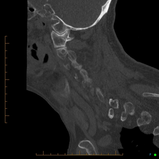 Cervical spine fracture - ankylosing spondylitis (Radiopaedia 76835-88706 Sagittal bone window 83).jpg