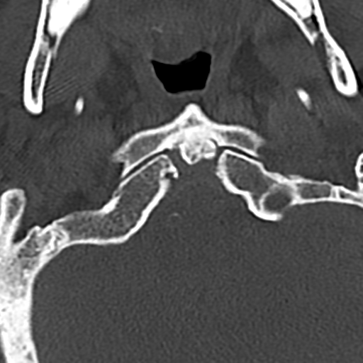 File:Cervical spine fracture - chalk stick (Radiopaedia 39116-41323 Axial bone window 10).png