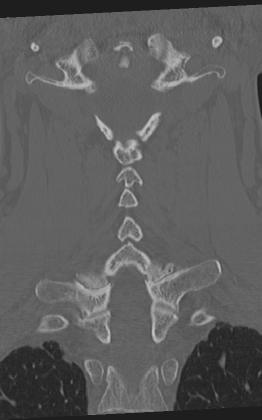 Cervical spine fractures with vertebral artery dissection (Radiopaedia 53296-59268 Coronal bone window 42).png