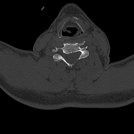 Cervical spine trauma with tear drop fracture and perched facet joint (Radiopaedia 53989-60127 Axial bone window 110).jpg