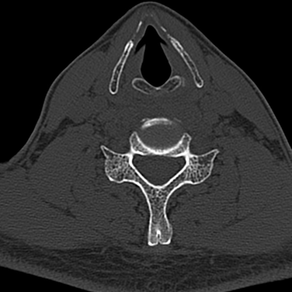 Cervical spondylodiscitis (Radiopaedia 28057-29489 Axial bone window 52).jpg