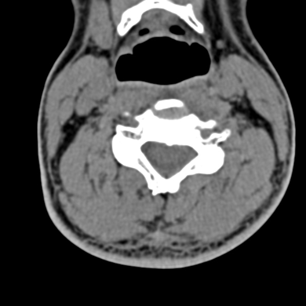 Cervical spondylodiscitis (Radiopaedia 28057-29489 Axial non-contrast 39).jpg