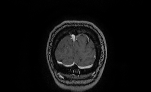 File:Cervical spondylodiscitis and calvarial hemangioma (Radiopaedia 64317-73103 Coronal T1 C+ 71).jpg