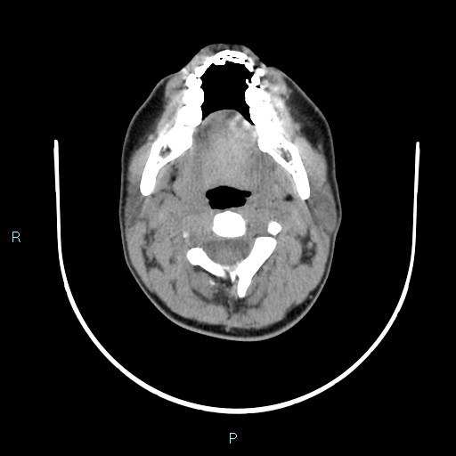 File:Cervical thymic cyst (Radiopaedia 88632-105335 Axial non-contrast 83).jpg