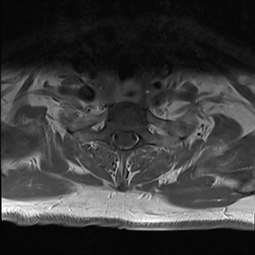 File:Cervical tumor-like myelopathy due to Type V dAVF (Radiopaedia 82461-96604 Axial T1 C+ fat sat 32).jpg