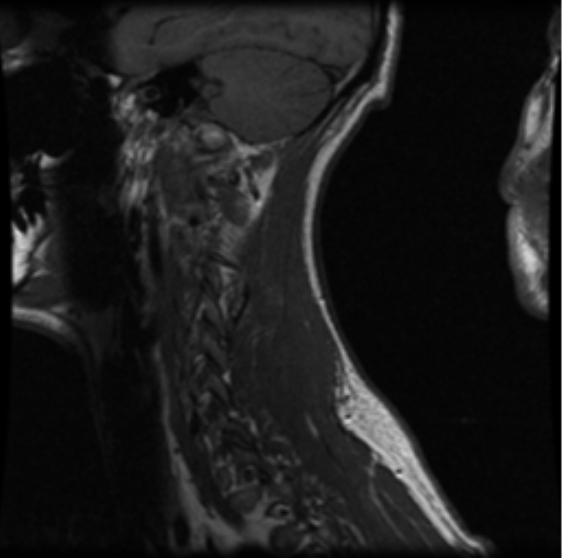 File:Cervical vertebrae metastasis (Radiopaedia 78814-91667 Sagittal T1 12).png