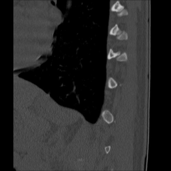 Chance fracture (Radiopaedia 36521-38081 Sagittal bone window 62).jpg