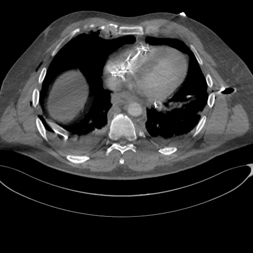 File:Chest multitrauma - aortic injury (Radiopaedia 34708-36147 A 204).png