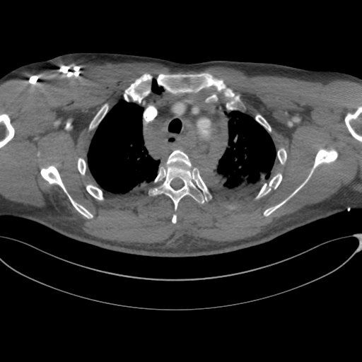 File:Chest multitrauma - aortic injury (Radiopaedia 34708-36147 A 68).png