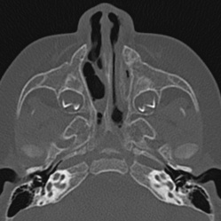 Choanal atresia (Radiopaedia 88525-105975 Axial bone window 29).jpg