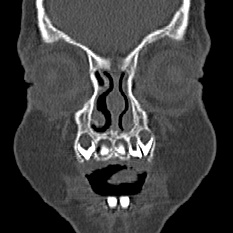 Choanal atresia (Radiopaedia 88525-105975 Coronal bone window 1).jpg