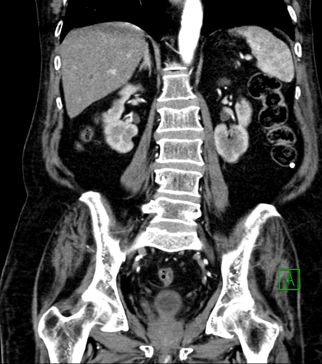 Cholangiocarcinoma with cerebral metastases (Radiopaedia 83519-98629 E 57).jpg