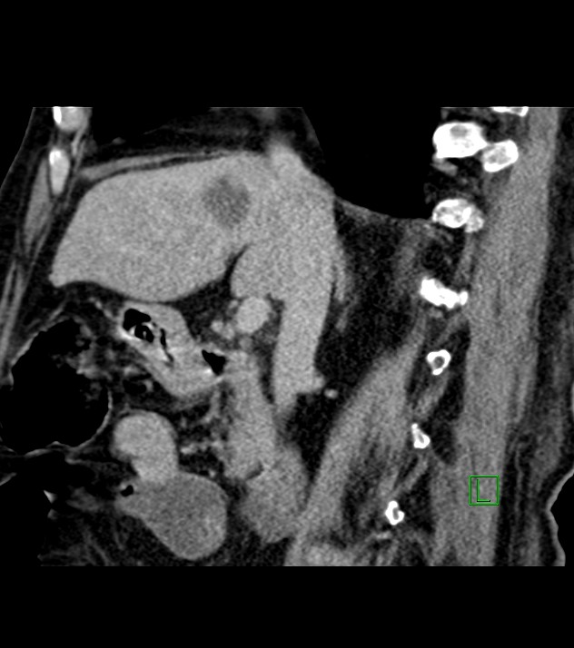 Cholangiocarcinoma with cerebral metastases (Radiopaedia 83519-98629 Sagittal C+ delayed 66).jpg