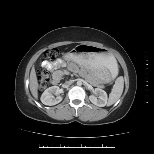 File:Choledochal cyst with chronic calcific pancreatitis (Radiopaedia 18245-18061 A 15).png