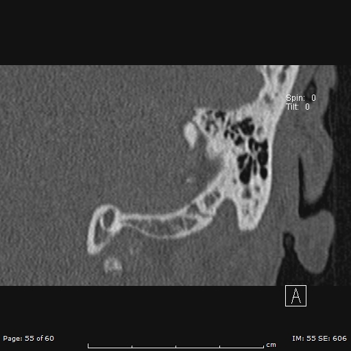 Cholesteatoma - external auditory canal (Radiopaedia 88452-105096 Coronal bone window 55).jpg
