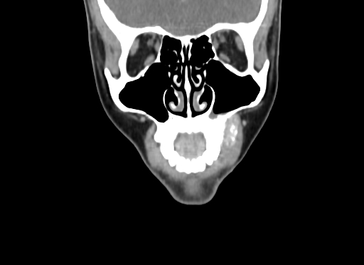 Chondroblastic osteosarcoma (Radiopaedia 67363-76741 D 26).jpg