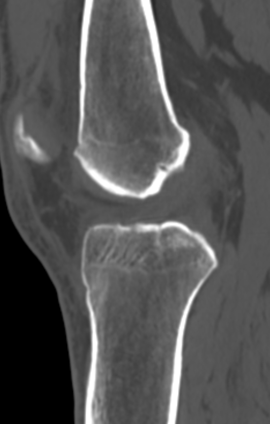 Chondrocalcinosis (Radiopaedia 82862-97173 Sagittal bone window 33).jpg