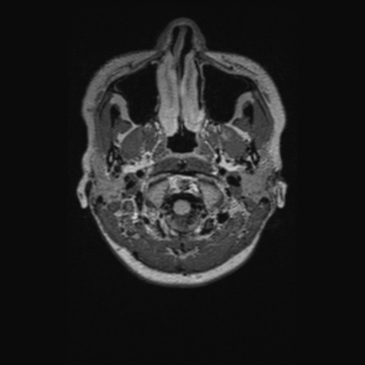 Chondrosarcoma (Radiopaedia 41937-44939 Axial FLAIR 6).png