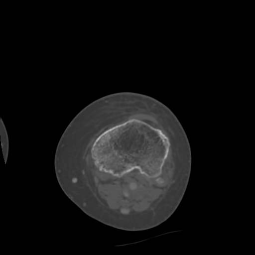 Chondrosarcoma - femur (Radiopaedia 64187-72954 Axial bone window 61).jpg