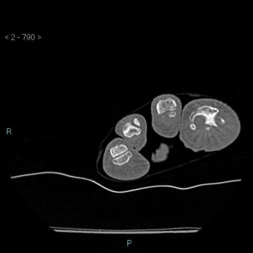 Chondrosarcoma - phalanx (Radiopaedia 69047-78812 Axial bone window 44).jpg