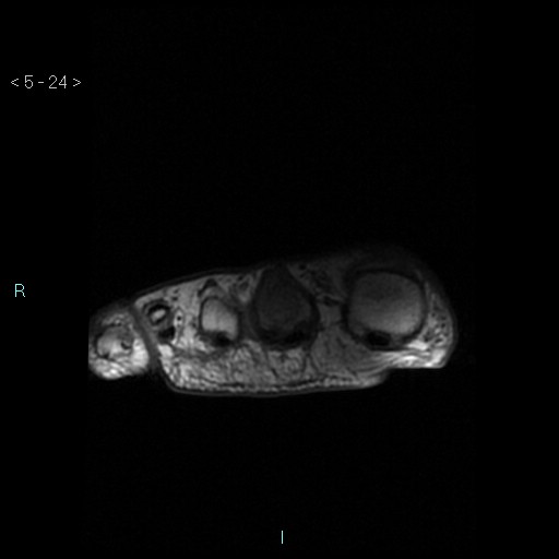 File:Chondrosarcoma - phalanx (Radiopaedia 69047-78813 Axial T1 24).jpg