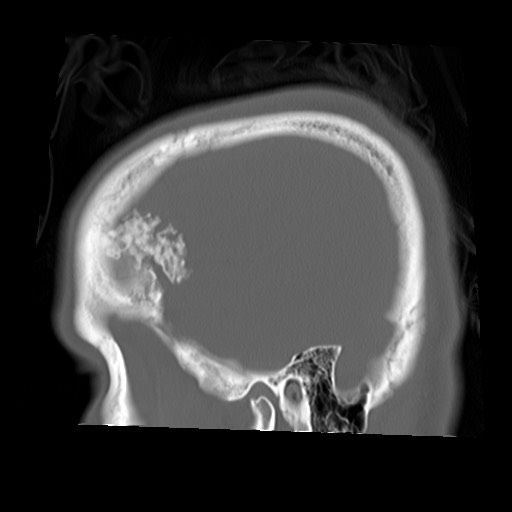 File:Chondrosarcoma - sphenoid wing (Radiopaedia 58259-67828 Sagittal bone window 25).jpg