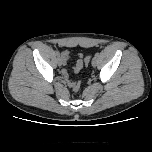 Chondrosarcoma of iliac wing (Radiopaedia 63861-72599 Axial non-contrast 80).jpg